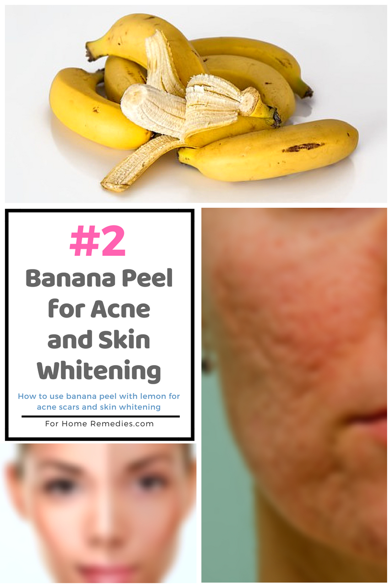  2 Quick Ways To Use Banana Peel For Acne Scars And Skin Whitening