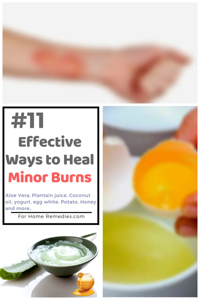How To Use Natural Home Remedies For Minor Burns Heal Fast 768x1152 