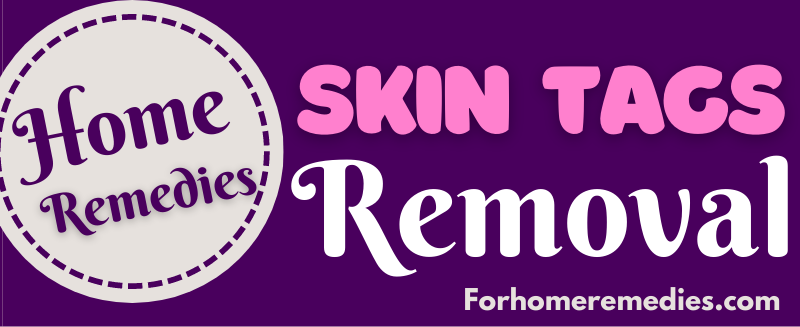 Quick & Easy Home Remedies for Skin Tags Removal